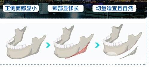 磨下頜角手術(shù)案例合集，磨骨手術(shù)科普~