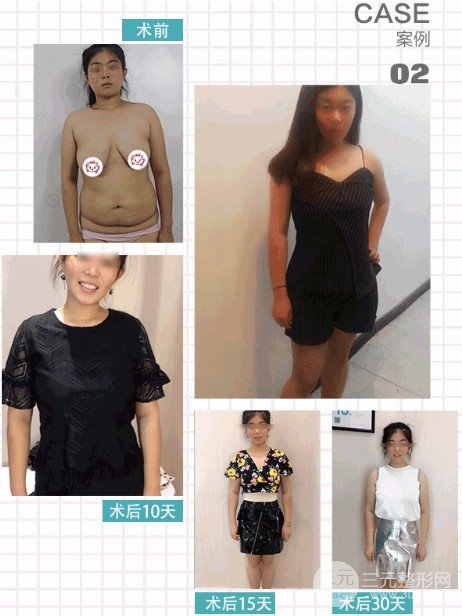 共振吸脂減肥果對比