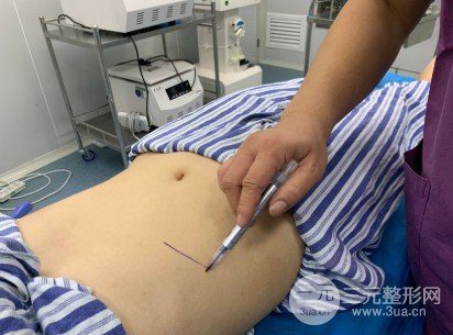 共振吸脂減肥果對比