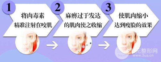 進口注射瘦臉多少錢