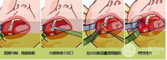 頰脂墊位置圖