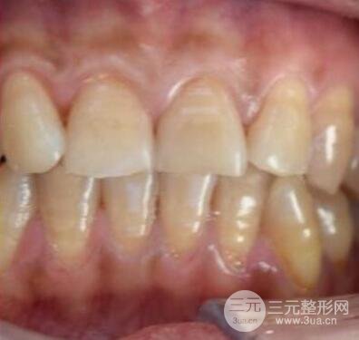 牙齒美白