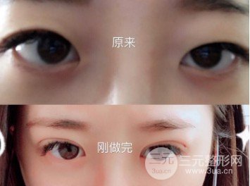 韓式微創(chuàng)雙眼皮過程