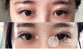 韓式微創(chuàng)雙眼皮過程