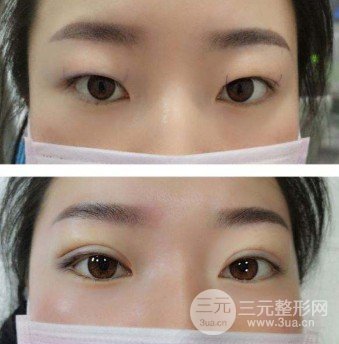韓式微創(chuàng)雙眼皮過程