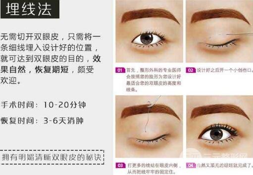 埋線雙眼皮