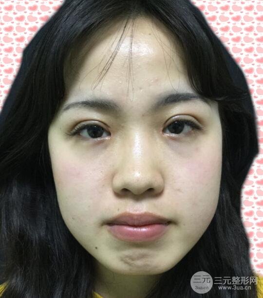 耳軟骨墊鼻尖失敗照片|鼻修復經(jīng)歷，鼻子第二次重生~