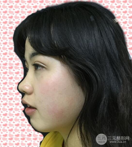 耳軟骨墊鼻尖失敗手術前