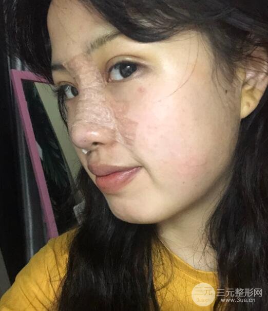 耳軟骨墊鼻尖失敗手術前
