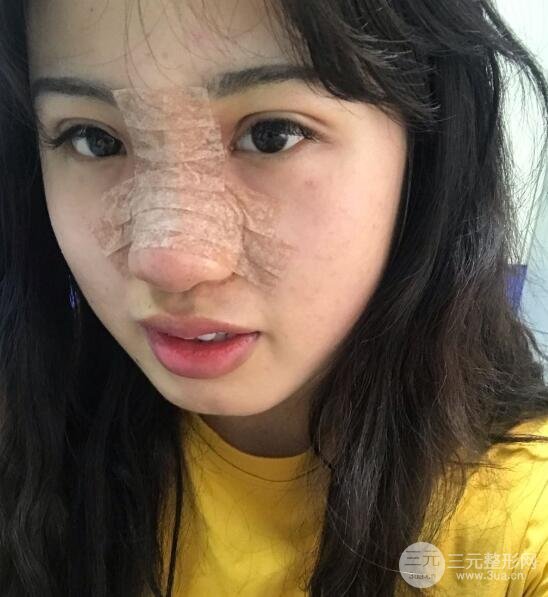 耳軟骨墊鼻尖失敗手術時