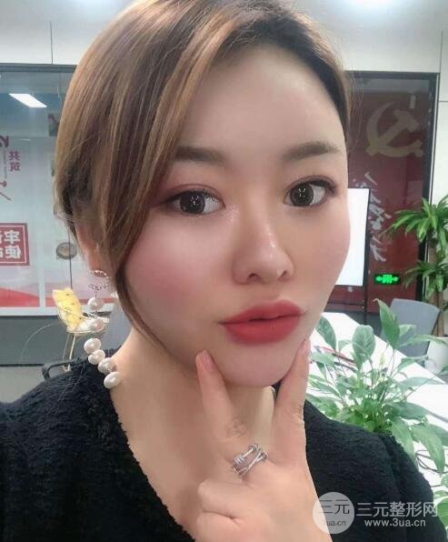 單眼皮整容后