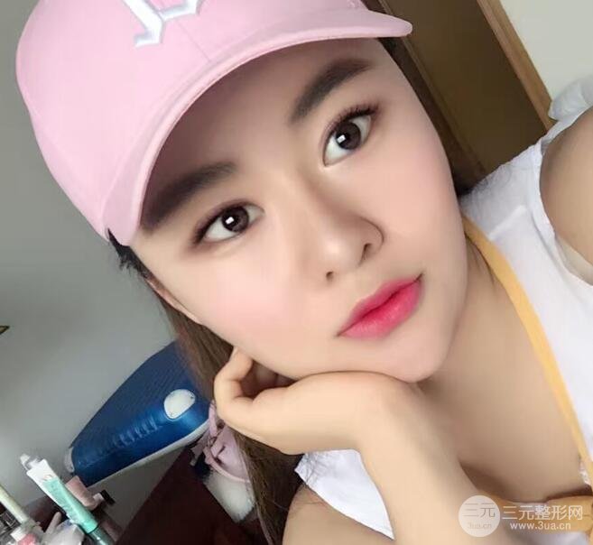 單眼皮整容后