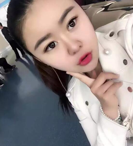 單眼皮整容后