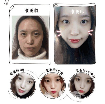 抽脂去眼袋費用貴