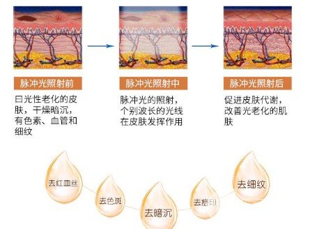 光子祛痘果