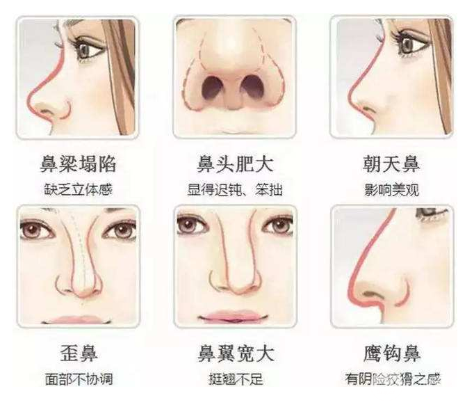 假體隆鼻手術降低風險嗎
