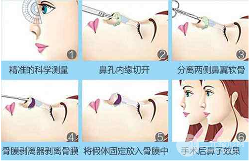 假體隆鼻手術降低風險嗎