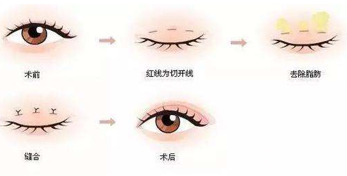 微創(chuàng)雙眼皮多久恢復(fù)自然