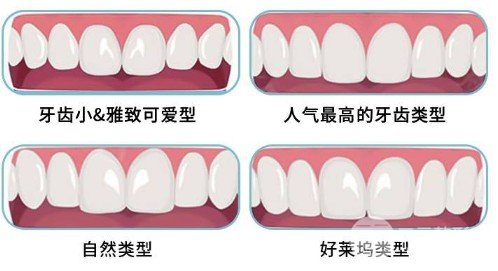 全瓷牙貼面全瓷牙