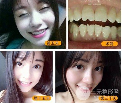 全瓷牙貼面全瓷牙