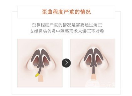 鼻梁歪整形手術(shù)果
