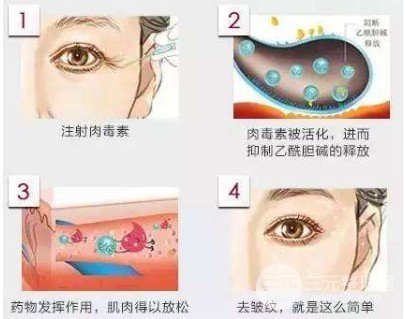打注射瘦臉多久能看到果