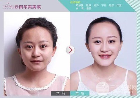 打注射瘦臉多久能看到果