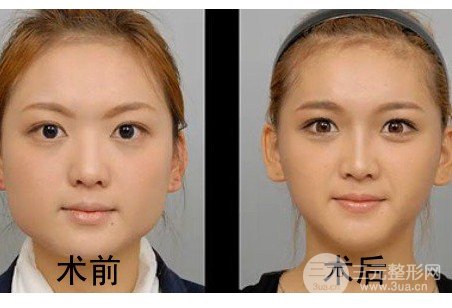 打注射瘦臉多久能看到果
