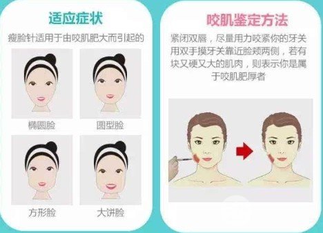 注射瘦臉