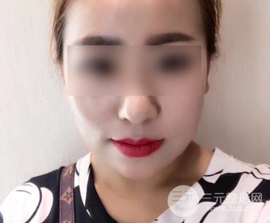 注射瘦臉