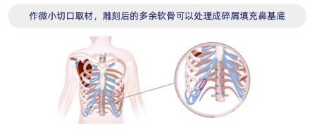 自體隆鼻價(jià)格多少