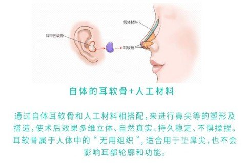 鼻梁骨整形要多少錢