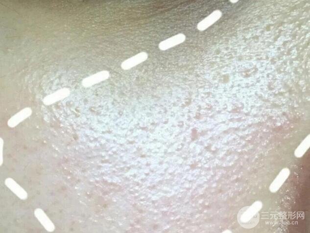 脂肪粒的自白：停用眼霜真的有用嗎？
