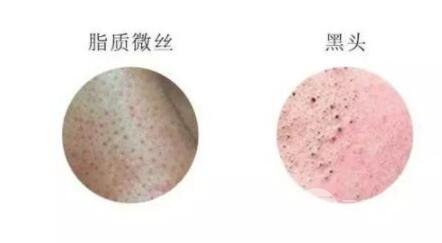 頑固黑頭：黑頭心中刺，拔掉萬般難！