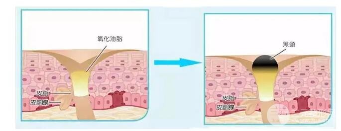 頑固黑頭：黑頭心中刺，拔掉萬般難！