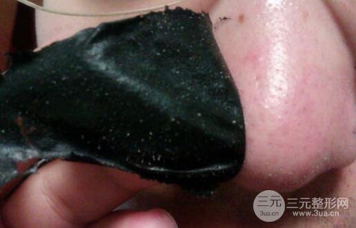 頑固黑頭：黑頭心中刺，拔掉萬般難！