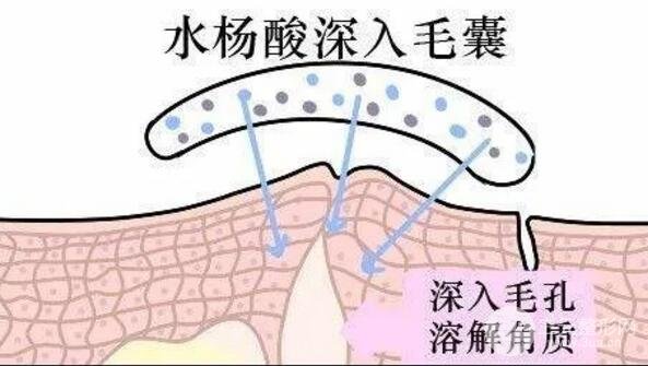 頑固黑頭：黑頭心中刺，拔掉萬般難！