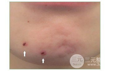 去痦子的方法