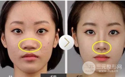 怎樣使鼻子變小