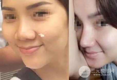 怎樣使鼻子變小
