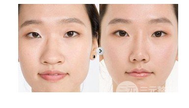 怎樣使鼻子變小