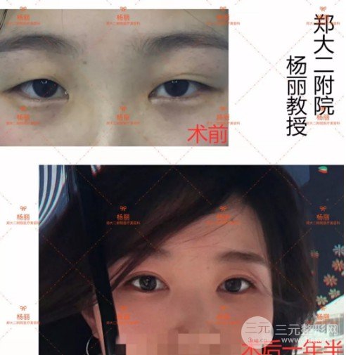 做雙眼皮手術(shù)恢復(fù)時(shí)間