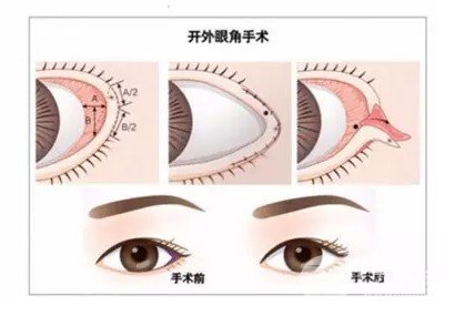開外眼角前后對比