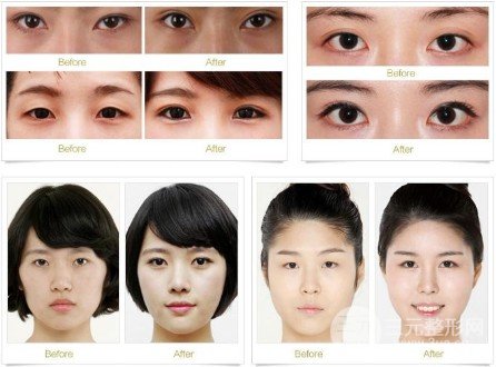 開外眼角前后對比