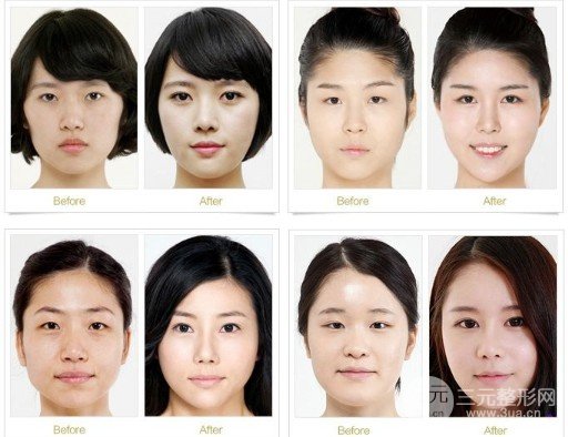 開外眼角前后對比