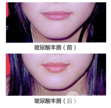 玻尿酸注射豐唇方法