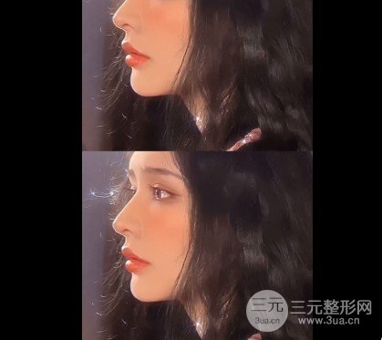 玻尿酸注射豐唇方法