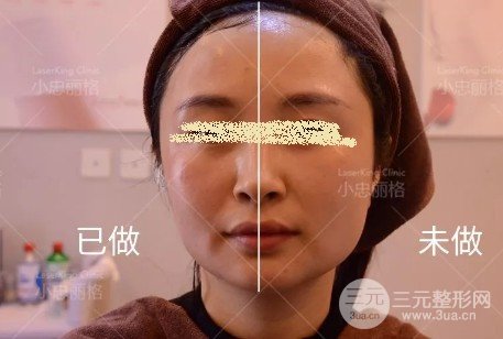 熱瑪吉和埋線除皺哪個好