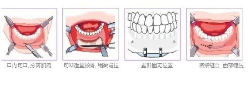 墊下巴多長(zhǎng)時(shí)間恢復(fù)