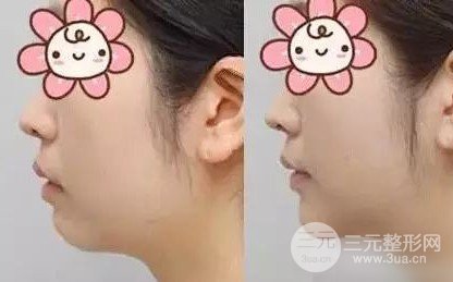 墊下巴多長(zhǎng)時(shí)間恢復(fù)